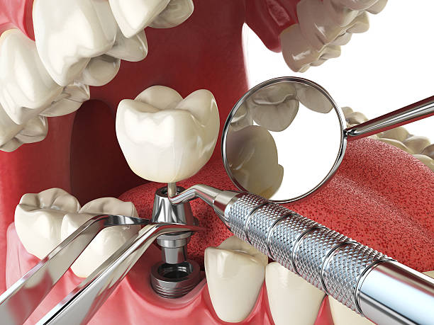 Best Broken or Cracked Tooth Emergency Dentist in Montgomeryville, PA